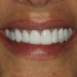 After porcelain veneers