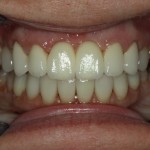 After smile makeover