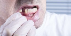 Man showing his broken tooth
