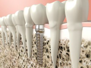 Dental Implant