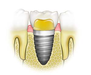 Image of a dental implant