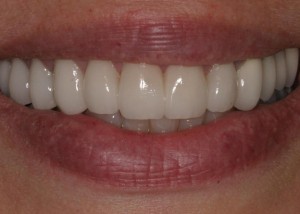 After teeth