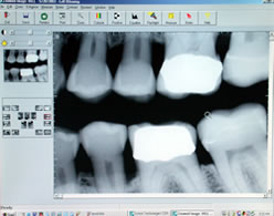 X-ray of teeth