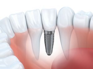 Tooth human implant