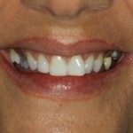 Before porcelain veneers